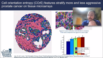 Andrew Janowczyk, (Case Western) describes an example of tissue analysis of prostate cancer. Andrew Janowczyk, (Case Western) describes an example of tissue analysis of prostate cancer.